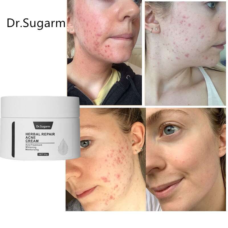 Dr.Sugarm Acne Removal Face Cream Dr.Sugarm Acne Removal Face Cream typesshop1   