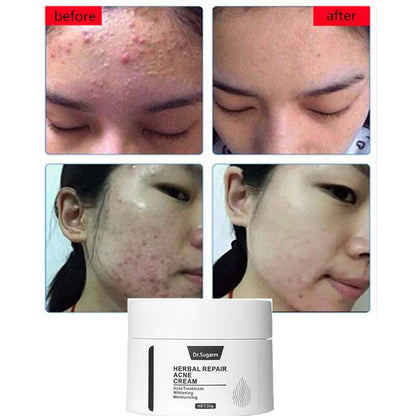 Dr.Sugarm Acne Removal Face Cream Dr.Sugarm Acne Removal Face Cream typesshop1   