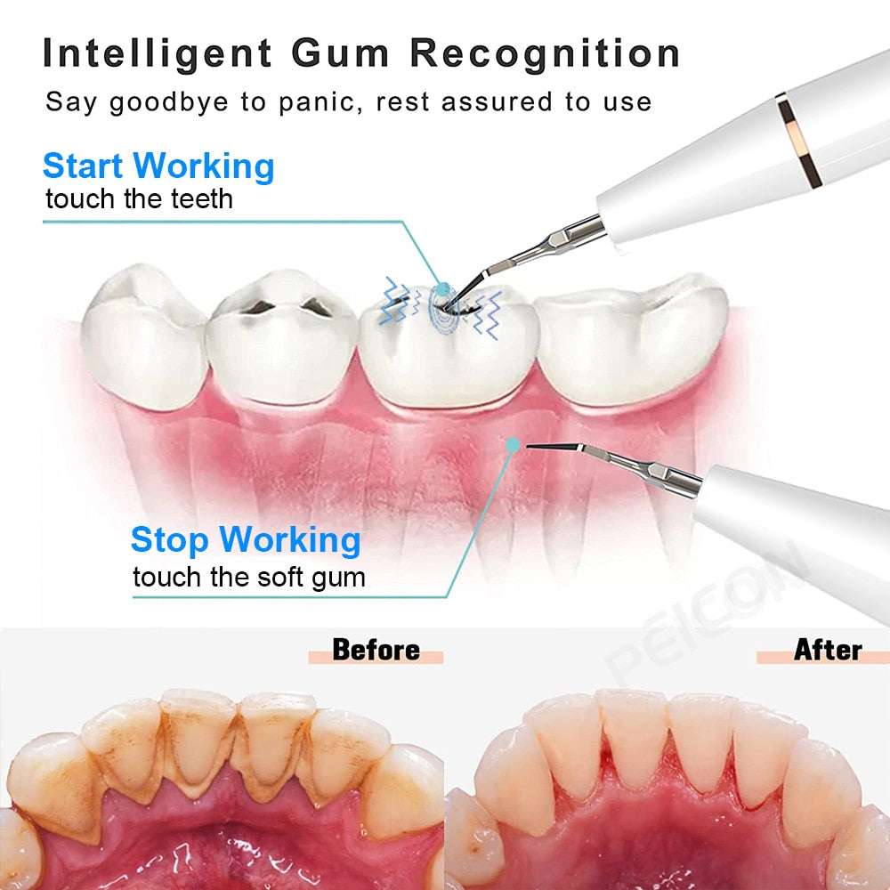 Ultrasonic Dental Scaler - Gifting By Julia M